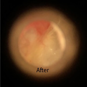 After Ear Wax Removal picture 1