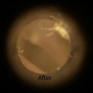 After Ear Wax Removal picture 2