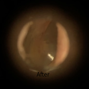 Picture after Wax removal 2