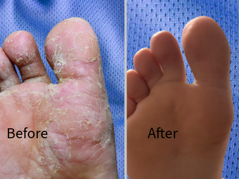 Athletes foot before and after treatment