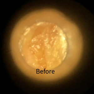 Before Ear Wax Removal picture 2
