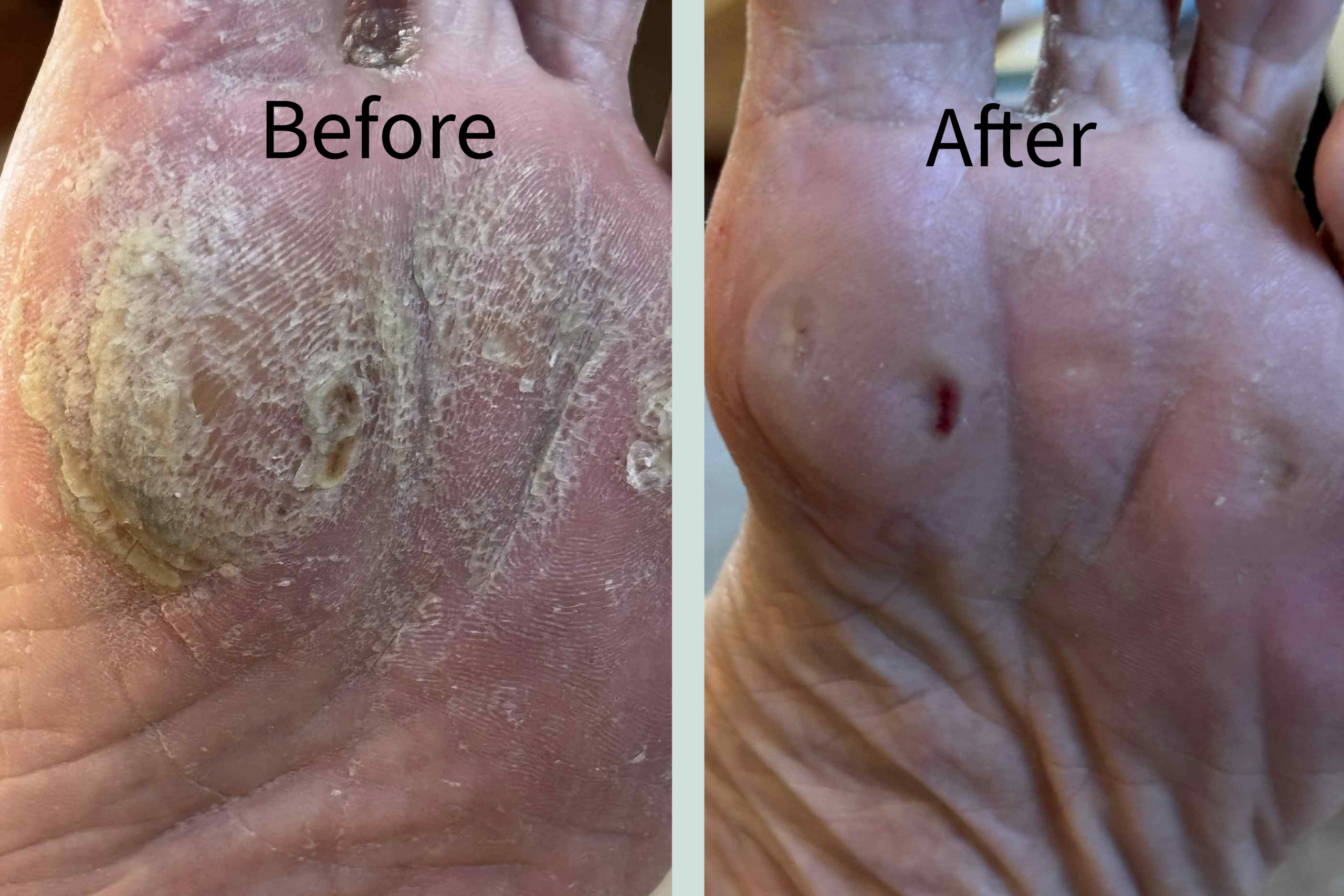 Picture of Callus Before & After