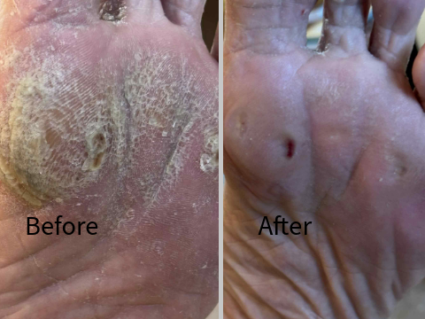Callus before and after treatment