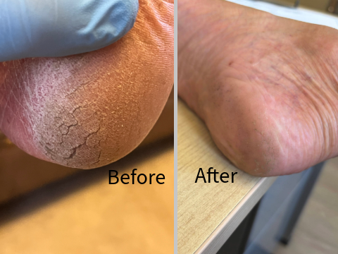 Cracked Heels before and after treatment