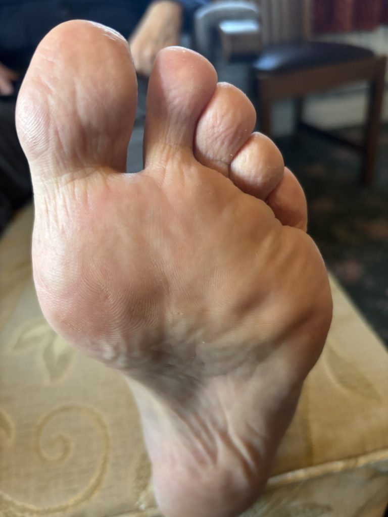 Verruca after Verrutop foot care treatment