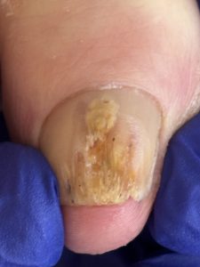 Fungal nail before Lacuna foot care treatment
