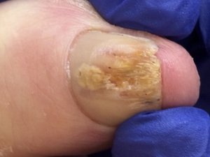 Fungal nail before Lacuna treatment