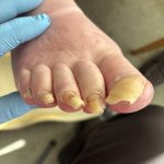 Picture of toenail before treatment