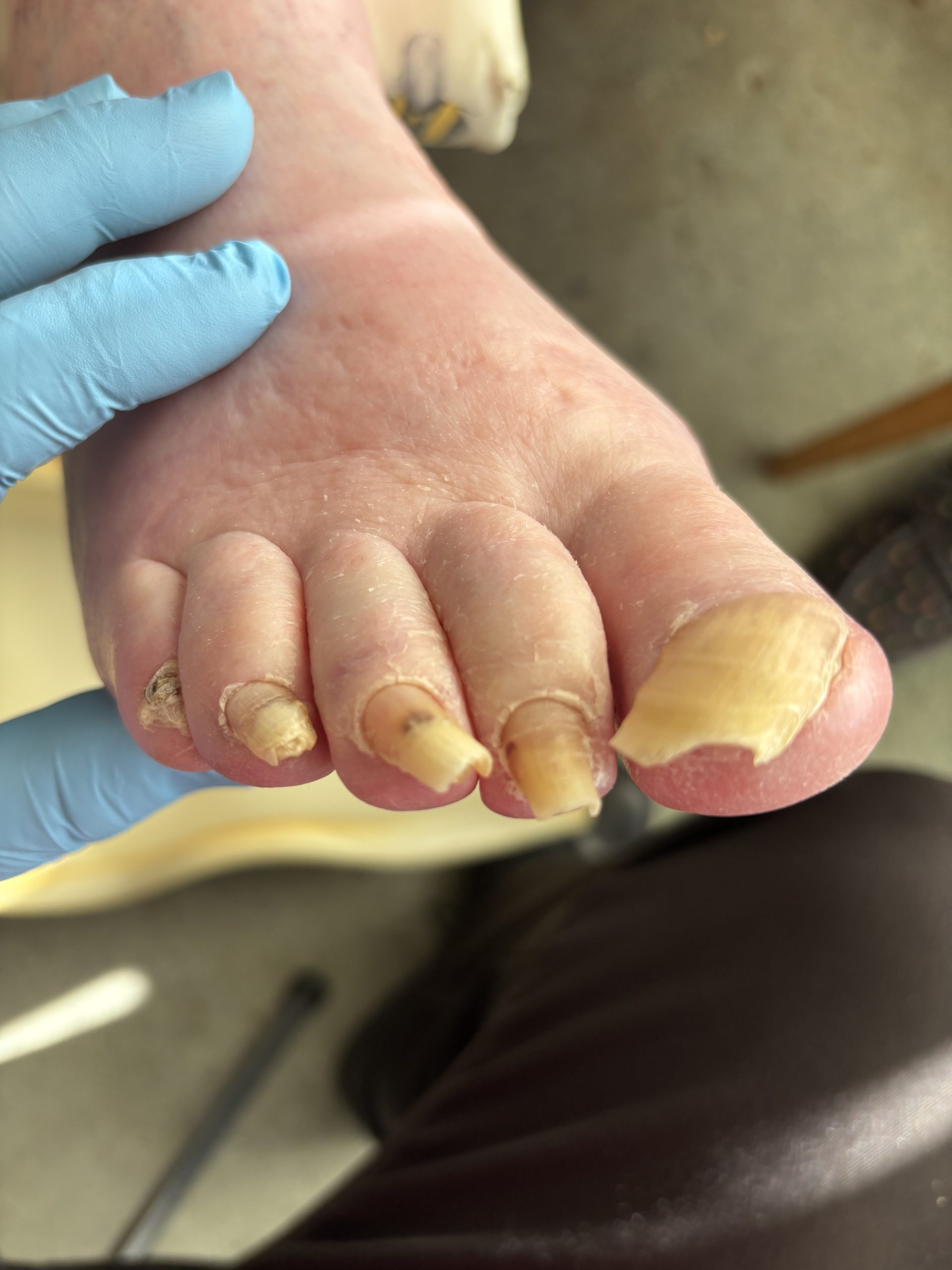 Picture of toenails before Routine foot care treatment