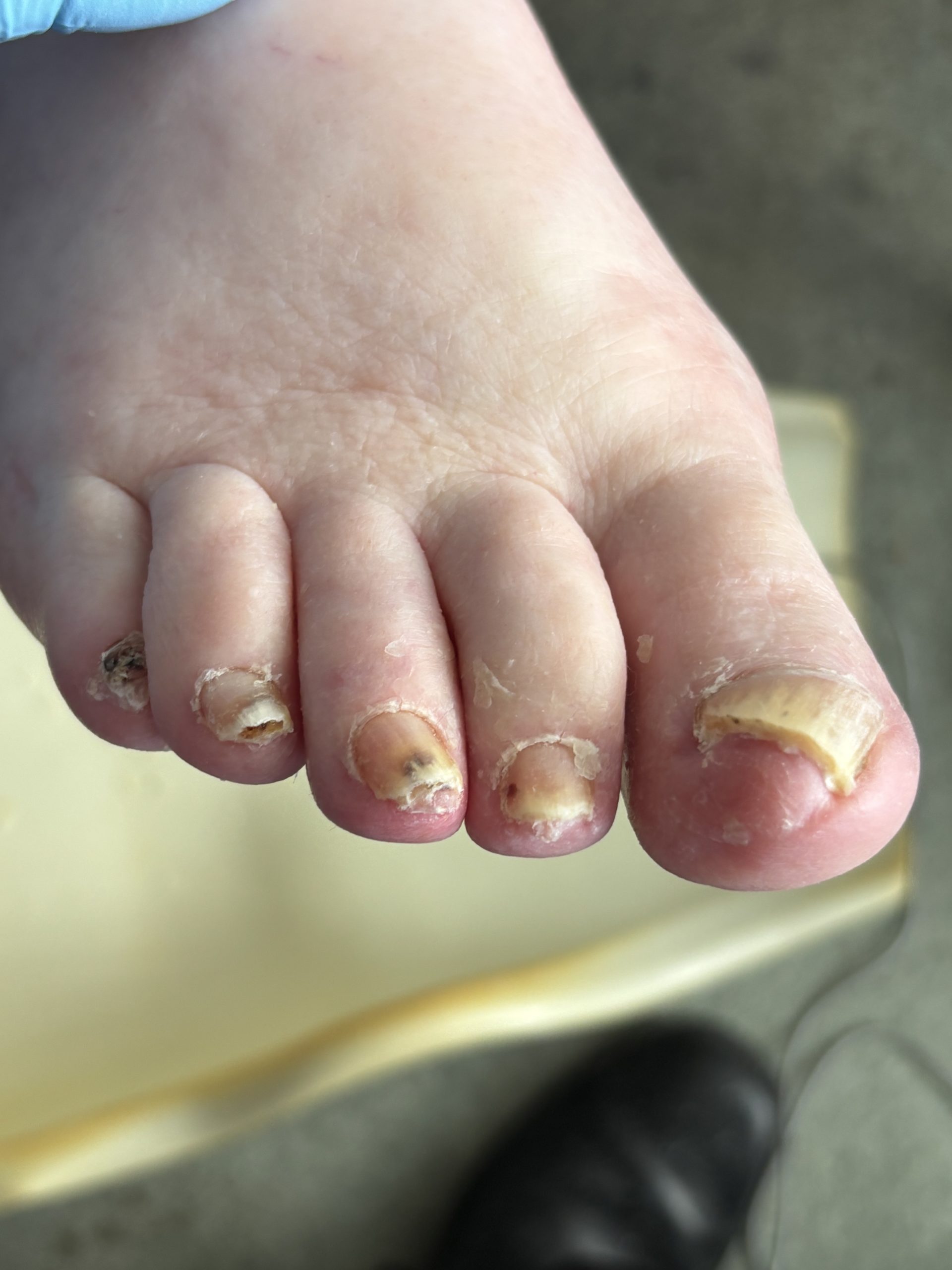 Picture of toenails after Routine foot care treatment