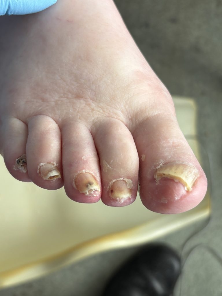 Picture of toenails after treatment
