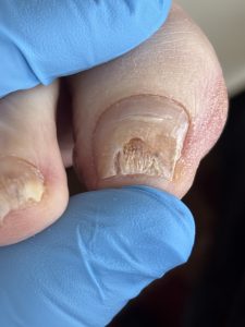 Fungal nail growing during Lacuna foot care treatment