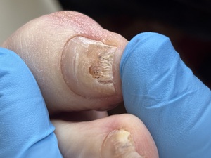 Fungal nail during Lacuna treatment