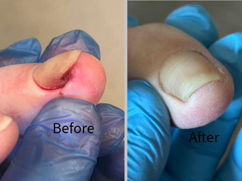Ingrown Toenail before and after treatment