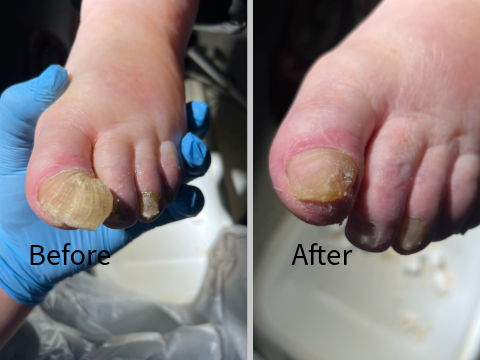 Thick Nail before and after treatment