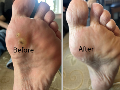 Verruca before & After