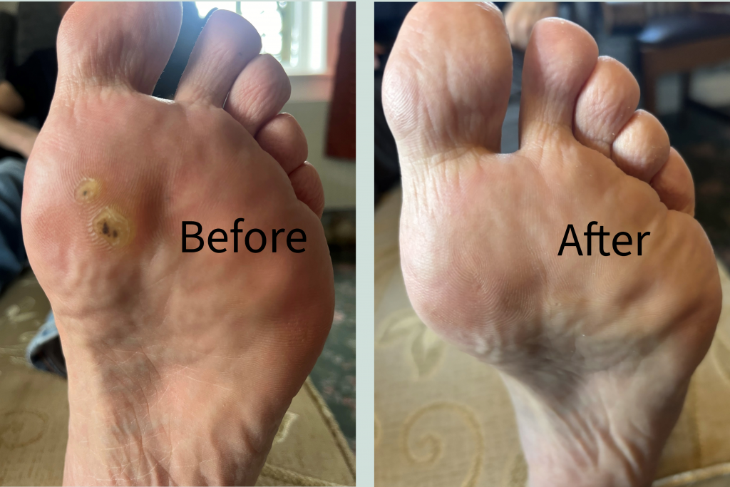 Foot Care picture of a Verruca before & after