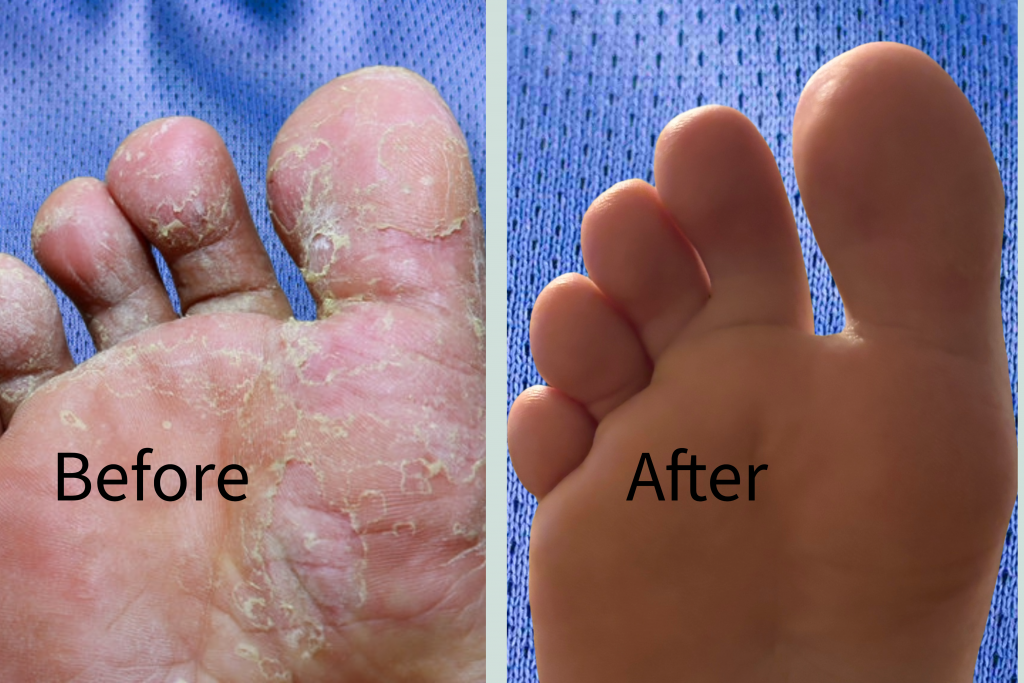 Foot Care picture of Athlete's Foot before & after